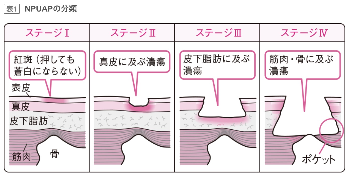 褥瘡治療の外用薬とドレッシング材(創傷被覆材) | Dr.クルクルの徒然日誌